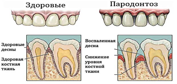 Пародонтоз болючий перестанет мучить! До глубокой старости будем грызть орехи, если применяем мы рецепты эти!