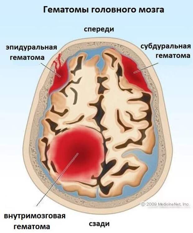 гематомы головного мозга