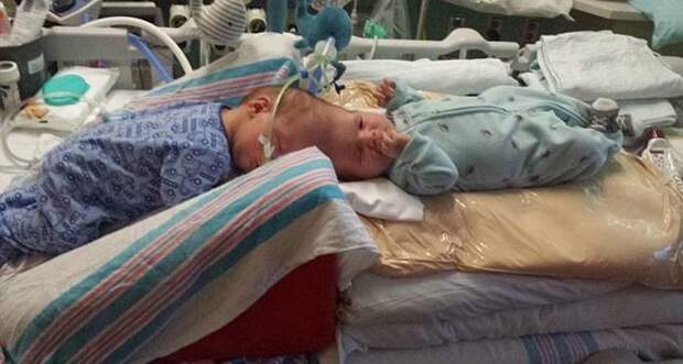 В США успешно разделили близнецов-краниопагов дети, операция, сша