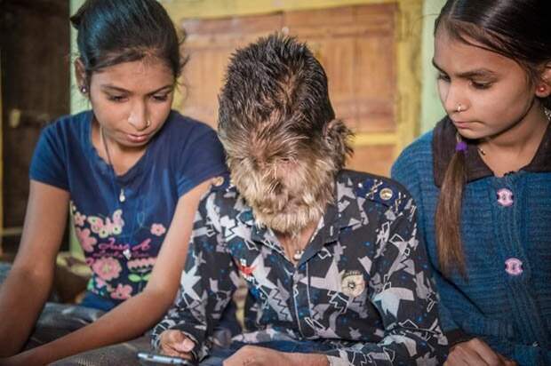 Лалит Патидар - 13-летний мальчик из Индии с необычной внешностью