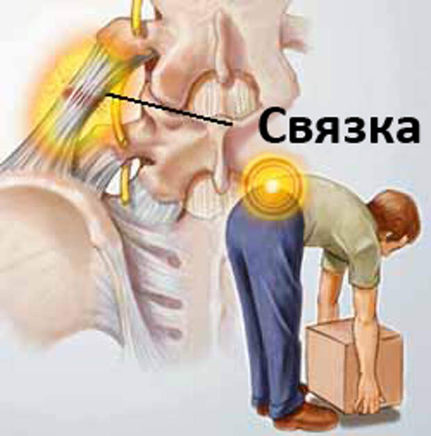 Резко поднял. Повреждение связок позвоночника. Разрыв межпозвоночных связок. Растянуть связку позвоночника. Перерастяжение межпозвоночных связок.