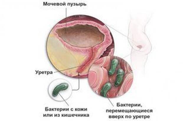 Bolezni_mochevogo_puzyrya_u_zhenshchin_simptomi_lechenie