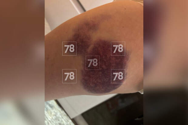 Пострадавшая в аварии с лодкой в Карелии сообщила о странном поведении водителя