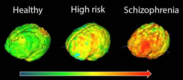 Как изменяется мозг при шизофрении