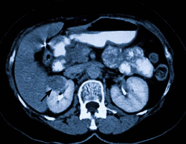 Исследование забрюшинного пространства методом магнитно-резонансной томографии