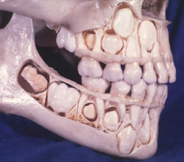 8. Так выглядит череп ребенка до того, как у него выпадают молочные зубы: интересные фото, удивительное рядом, факты