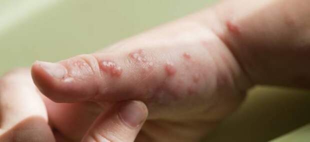 Болячки на руках: фото, симптомы, диагностика и лечение