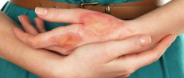 Болячки на руках: фото, симптомы, диагностика и лечение