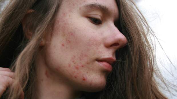 Врач показала покрытое прыщами лицо и взволновала россиян