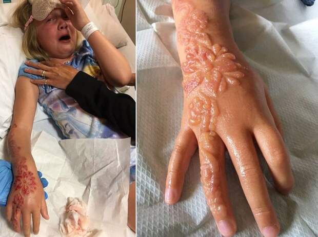 Рука девочки покрылась огромными волдырями после нанесения временной тату хной в Египте в мире, волдыри, дети, египет, люди, рука, хна