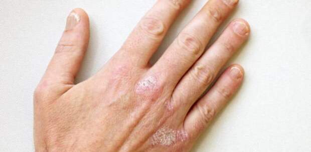 Болячки на руках: фото, симптомы, диагностика и лечение