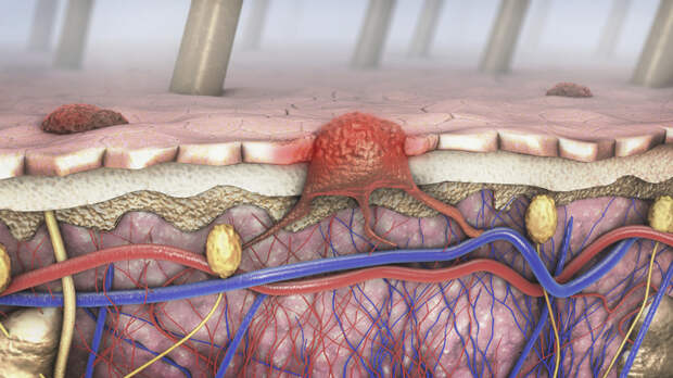 Минздрав одобрил мРНК-вакцину от меланомы