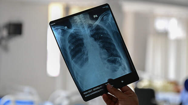 Онколог Долгополов: рак лёгких сложно обнаружить на ранних стадиях