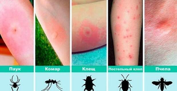 12 видов укусов насекомых и что делать при каждом из них (часть 2) 0