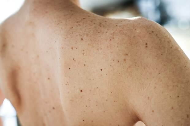 Ученый назвал неочевидный симптом рака