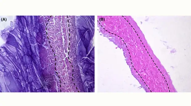 Остановить инфекцию: российские химики создали материал для имплантов с антибактериальным эффектом