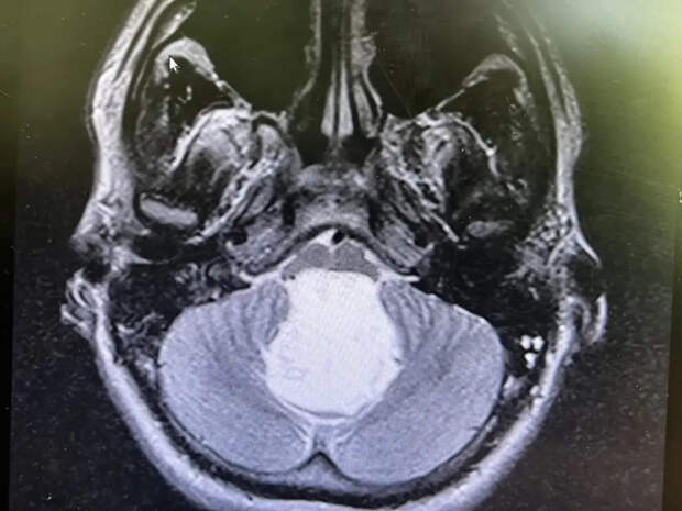 Новосибирские врачи спасли молодого человека от «жемчужной» опухоли