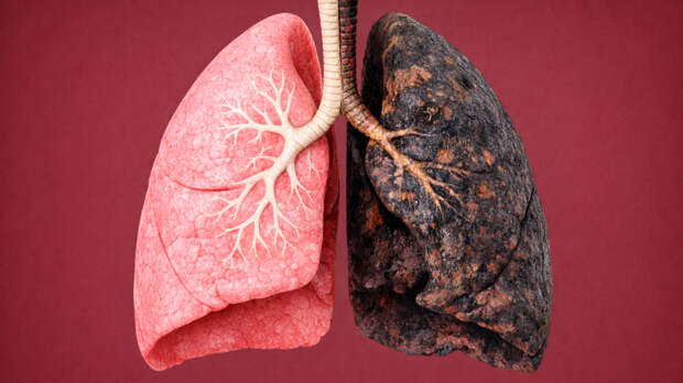 Рак легких: причины онкологии, симптомы по стадиям, выживаемость и лечение