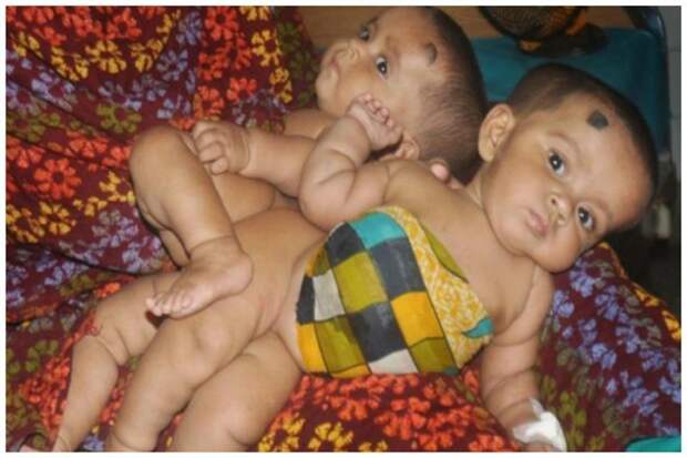 Тофа и Тахура Бегум близнецы сиамские, бывает же, выросли, жизнь, интересное, разделили
