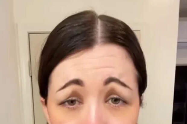 The Sun: американка рассмешила соцсети, показав результат инъекций ботокса