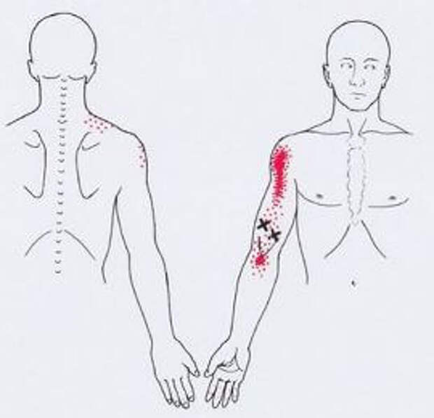 Триггерные точки карта отраженной боли