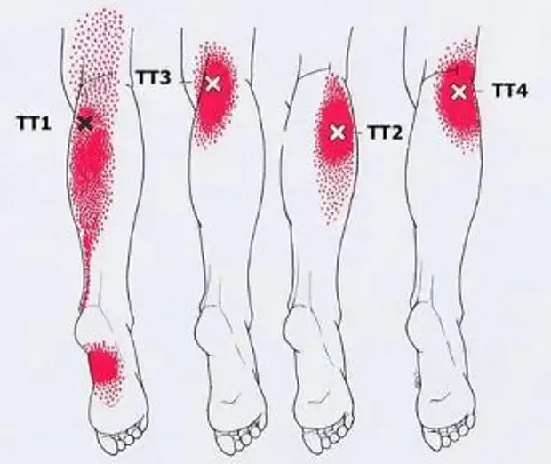 Карта точек боли в теле и точек напряжения мышц триггеры