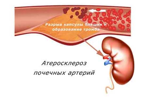 атеросклероз почечных артерий
