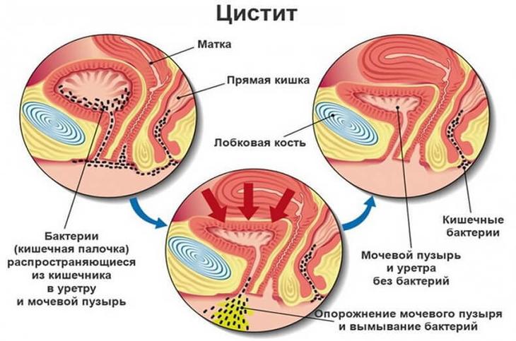 Доктор Евдокименко: Как вылечить цистит за 1 день – без таблеток и антибиотиков Доктор Евдокименко: Как вылечить цистит за 1 день – без таблеток и антибиотиков