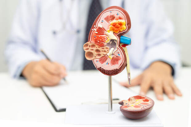 Врач Малхасян: при мочекаменной болезни важно потреблять меньше соли