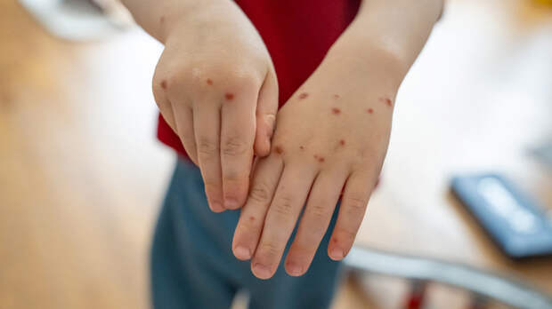 В Роспотребнадзоре прокомментировали сообщения о массовых вспышках вируса Коксаки в России