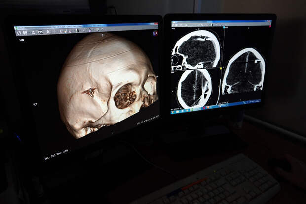 В Барнауле нейрохирурги извлекли пулю из мозга пациента спустя сутки после травмы