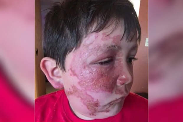 Metro: 9-летний повторил челлендж с микроволновкой из TikTok и получил ожоги