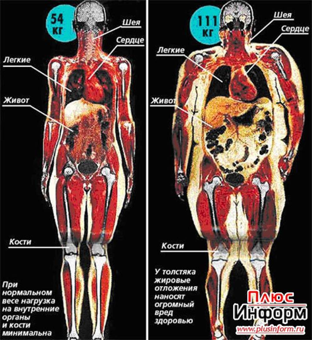 ожирение сердца фото