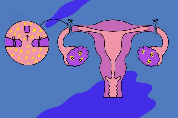 Женская стерилизация — метод контрацепции, который доступен женщинам старше 35 лет.