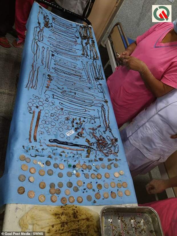 Хирурги извлекли из желудка женщины 1,5 кг ювелирных украшений и монет