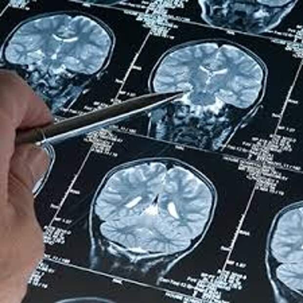 Доброкачественные и злокачественные опухоли на МРТ: ключевые отличия и диагностика