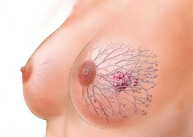 gogus-kanseri-tedavisi-hastaliga-yakalanmadan-4249912_1095_b 1111