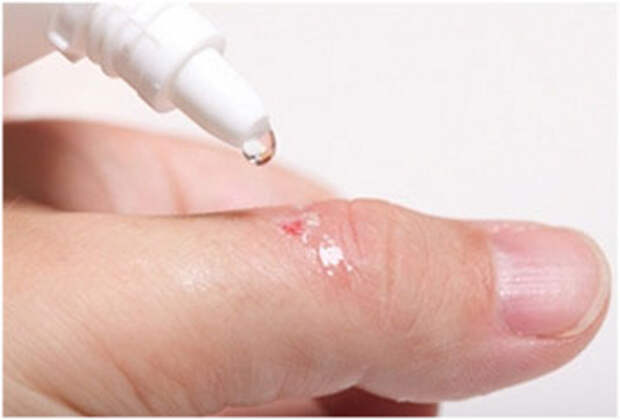 обработка раны на пальце