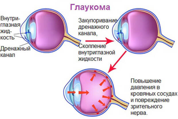 Глаукома: почему возникает это заболевание и как его можно избежать