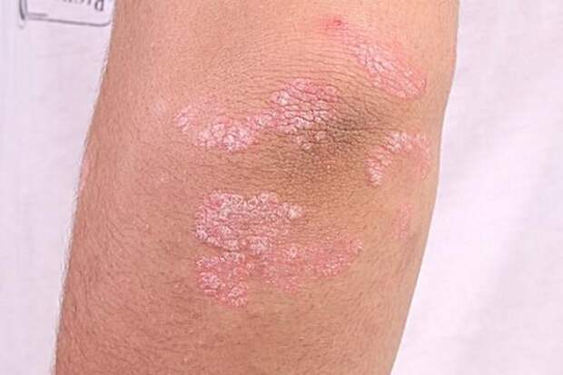 Самые лучшие китайские средства от псориаза