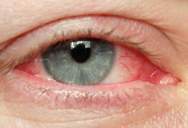 Глаукома: почему возникает это заболевание и как его можно избежать