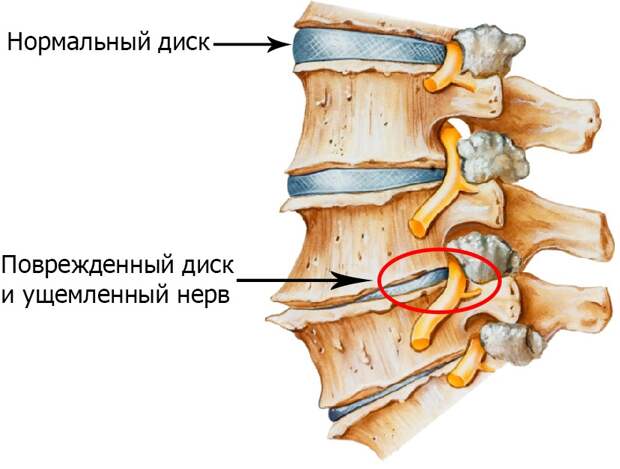 Risunok-3.-Zashhimlenie-nerva-pri-osteohondroze