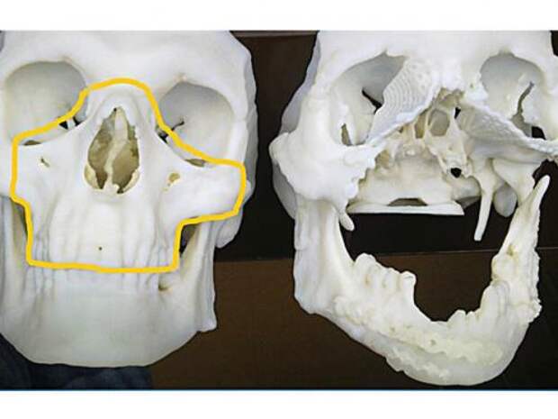 Компьютерная томография, предоставленная Онкологическим центром и Институтом онкологии в Гливице, Польша, показывает череп 33-летнего поляка после того, как он получил повреждения в результате несчастного случая (справа), рядом со здоровым черепом другого человека.