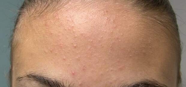 Угревая сыпь у подростка на лбу. Угревая сыпь у подростка на лбу.