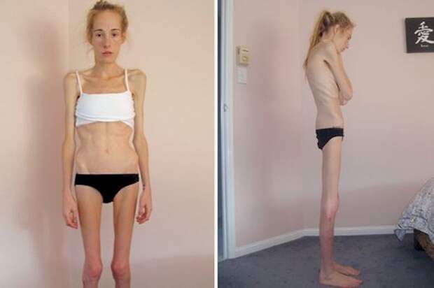До и после: история анорексички анорексичка, анорексия, до и после