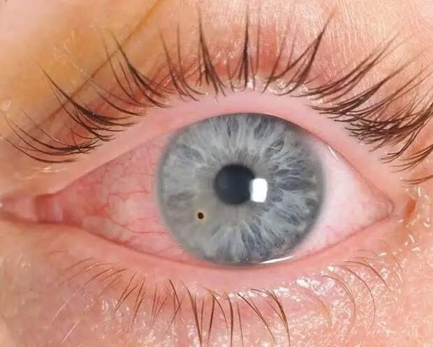 В Рязанской области число травм глаза выросло втрое