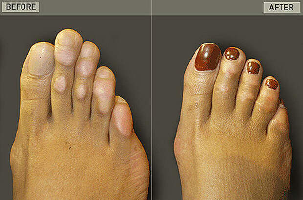 Хирургия Золушки - операция по укорачиванию пальцев ног