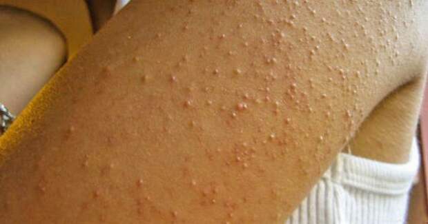 http://takprosto.cc/wp-content/uploads/s/simptomy-celiakii/thumb-600x315.jpg