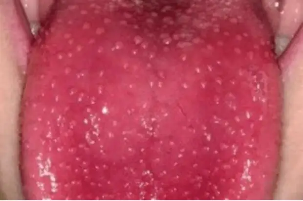 Что расскажет язык о вашем здоровье