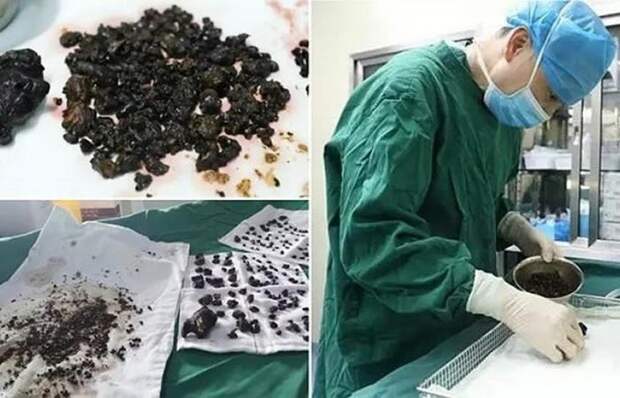 У Вас тут в желчном пузыре 200 камней завалялось...